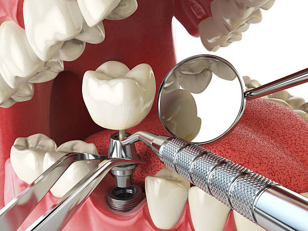 Best Emergency Dental Care for Broken or Chipped Teeth in Eufaula, AL